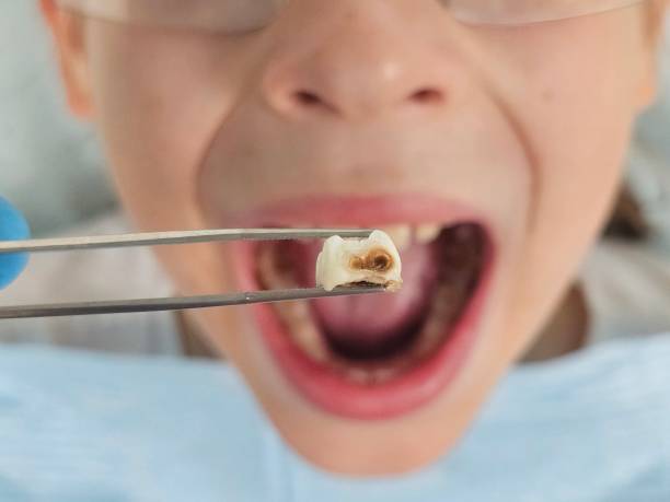 Best Emergency Tooth Extraction in Mount Vernon, OH